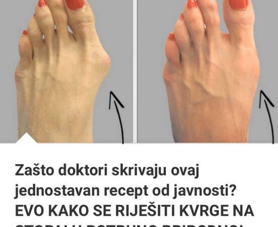 OTKRIVAMO KAKO SE RIJEŠITI KVRGE NA STOPALU POTPUNO PRIRODNO! (foto)