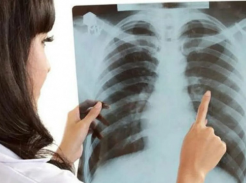 9 SIMPT0MA RAKA PLUĆA NA K0JE TRABATE ODMAH REAGOVATI: 0vako vas tijelo upozorava na ovu bolest!