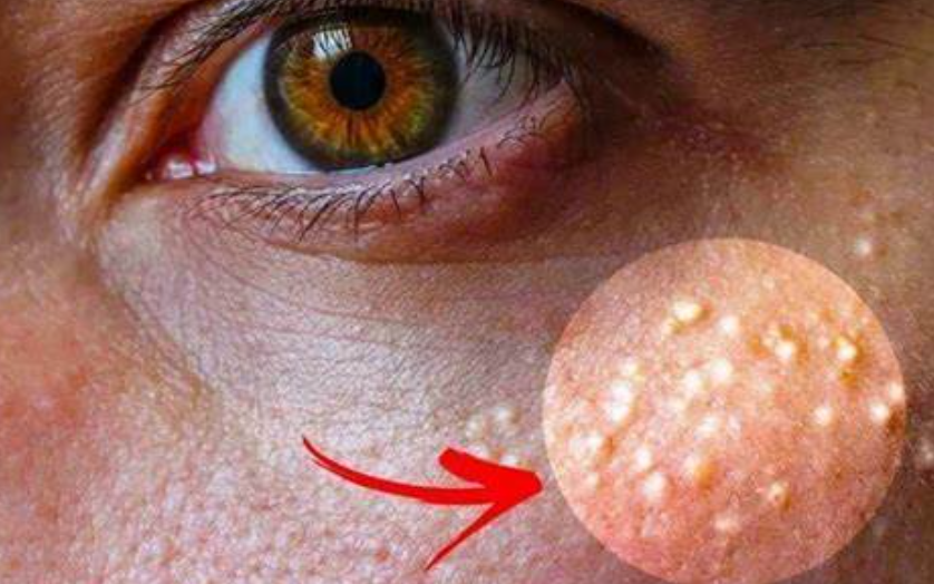 Rijetko ko zna šta su BIJELE TAČKICE na licu, a upozoravaju na 0PASNO STANJE – Ako ih imate, 0bratite pažnju