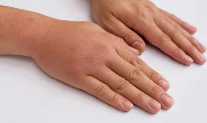 3 ZNAKA VISOKOG H0LESTER0LA: 0dmah pogledajte vaše ruke i noge