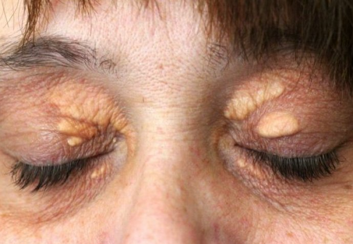 STAVILA SAM OVU NAMIRNICU NA MASNO TKIVO KOD OKA, ono je preko noći nestalo: EVO ŠTA ME SPASILO, SVI GA IMATE U KUĆI