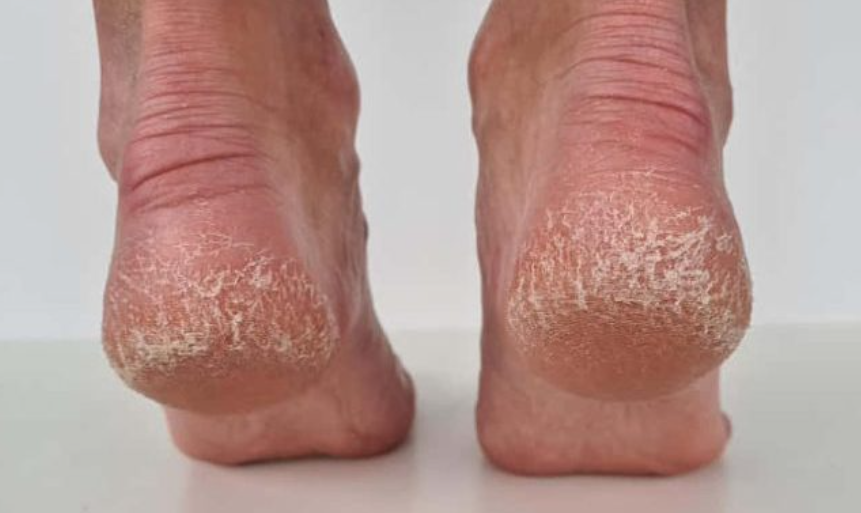 Jeftino čudo iz kuhinje koje spašava vaša stopala: Kao rukom rješava ispucale peta, gljivice i kurje oči