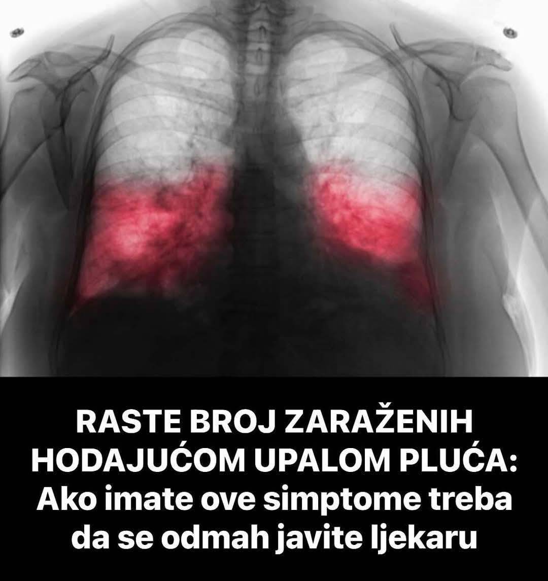 RASTE BROJ ZARAŽENIH HODAJUĆOM UPALOM PLUĆA: Ako imate ove simptome treba da se odmah javite ljekaru