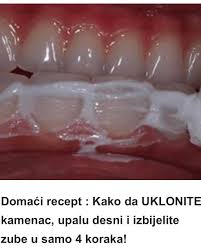 Domaći recept : Kako da UKLONITI kamenac, upalu desni i izbijeliti zube u samo 4 koraka!