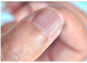 MATE LI OVAKVE IZBOČINE NA NOKTIMA – evo šta one znače: Doktorica otkrila i možda ćete se iznenaditi