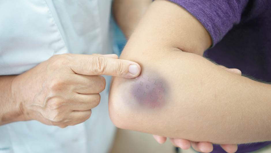 MODRICE JAVLJAJU PO TIJELU: NEMA VEZE SA POVREDAMA, PRAVI RAZLOG ĆE VAS ŠOKIRATI