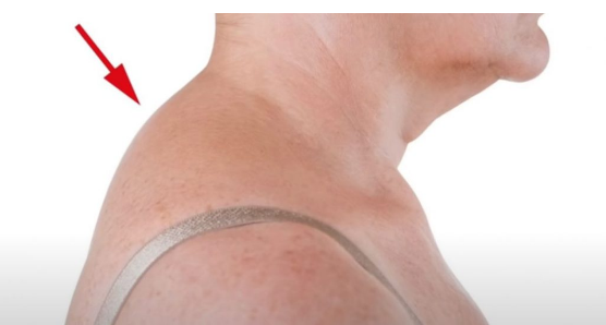 STVORILA VAM SE GRBA NA VRATU, EVO KAKO ĆETE JE ISPRAVITI: Trebate samo slediti Ovih 5 saveta!