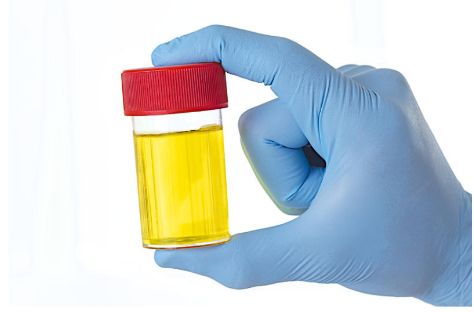 ZAŠTO IMATE JAK I NEPRIJATAN MIRIS URINA: Ovaj znak organizma ne smijete zanemariti! EVO NA ŠTA VAS UPOZORAVA